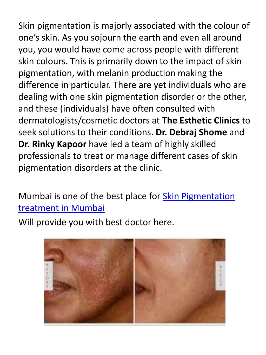 PPT - Best Skin Pigmentation Treatment in India PowerPoint Presentation ...