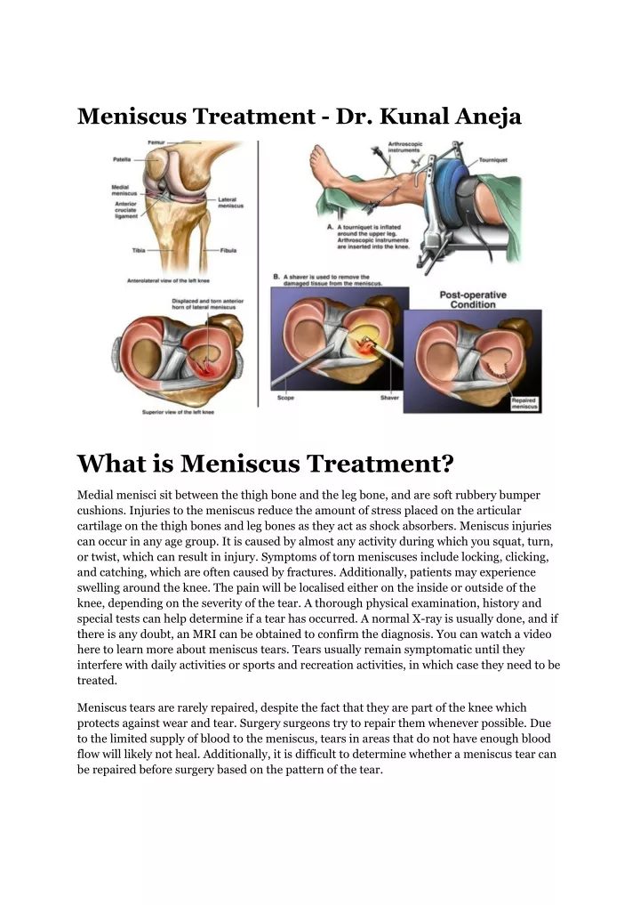 Ppt Meniscus Treatment Dr Kunal Aneja Powerpoint Presentation Free Download Id