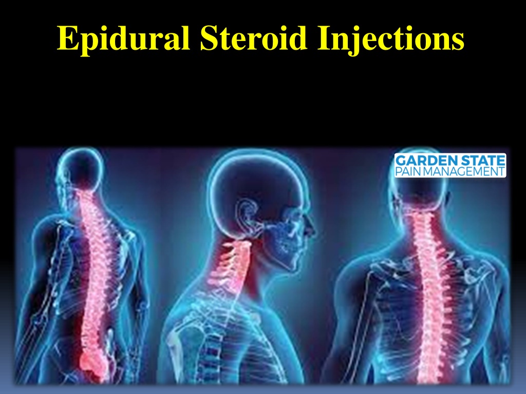 PPT Epidural Steroid Injections PowerPoint Presentation, free