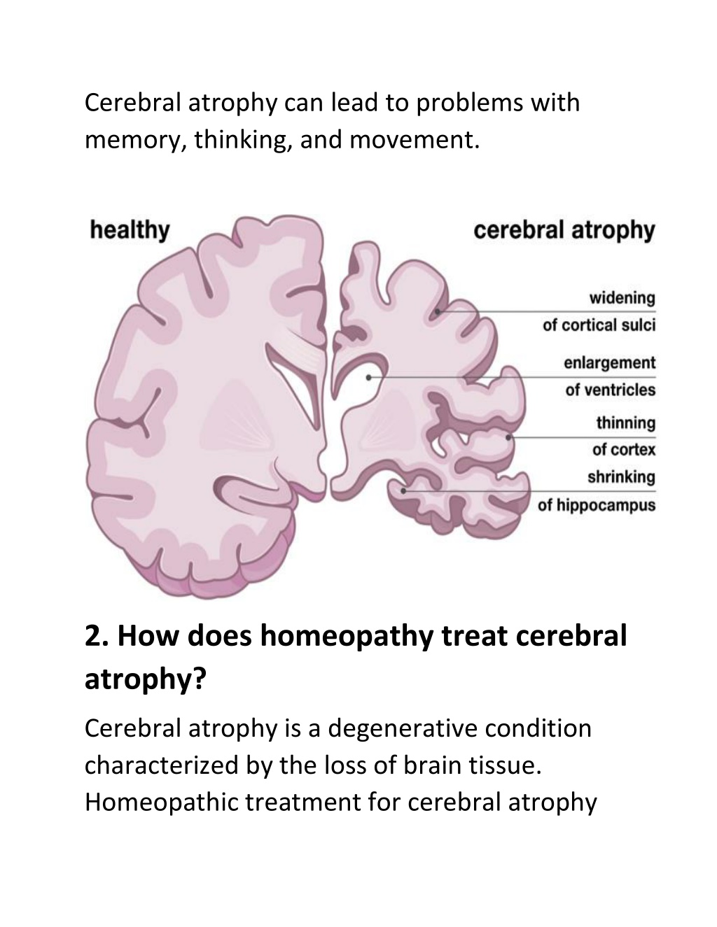 PPT - Best Homeopathic Cerebral Palsy Treatment | Cerebral Atrophy ...