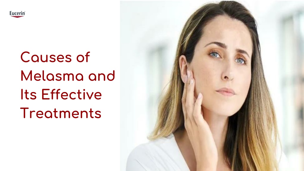 PPT - What are the Causes and Treatments of Melasma PowerPoint ...