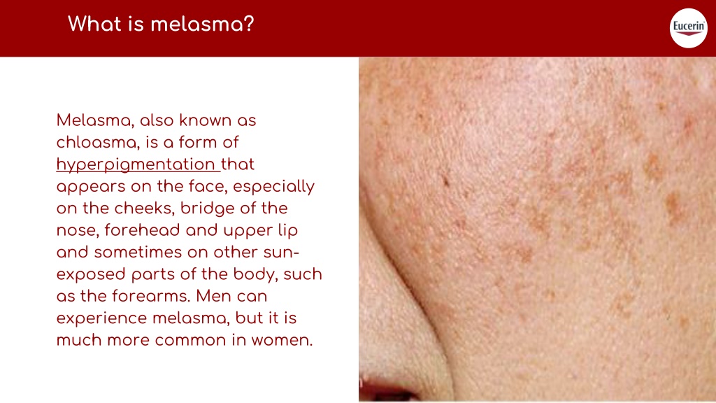 PPT - What are the Causes and Treatments of Melasma PowerPoint ...