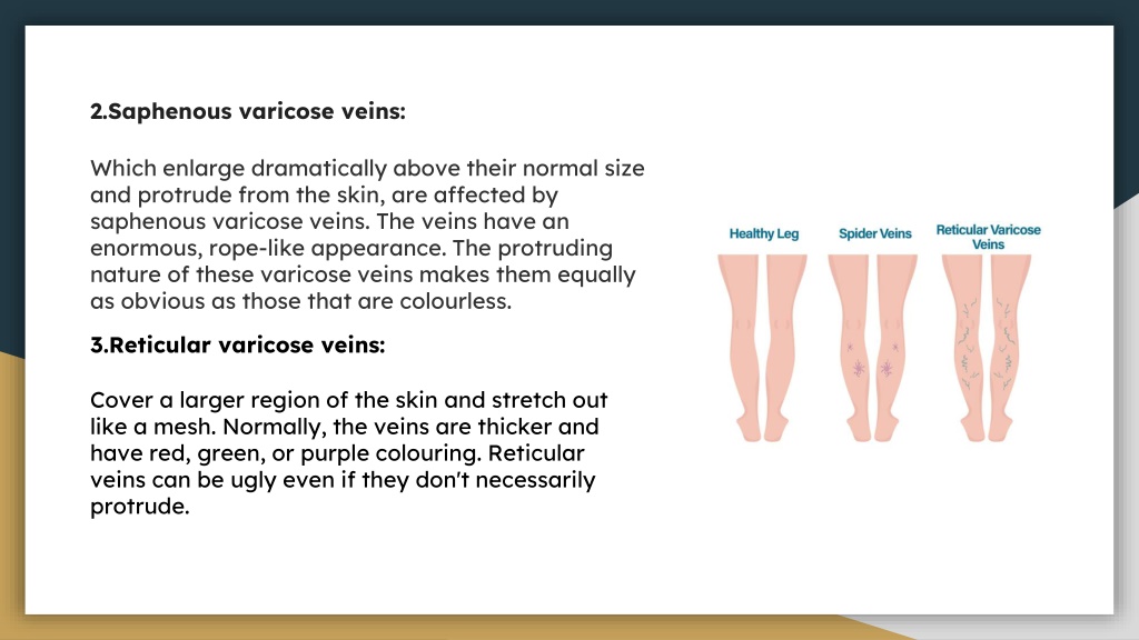 PPT - VARICOSE VEINS, CAUSES,TREATMENT (1) PowerPoint Presentation ...