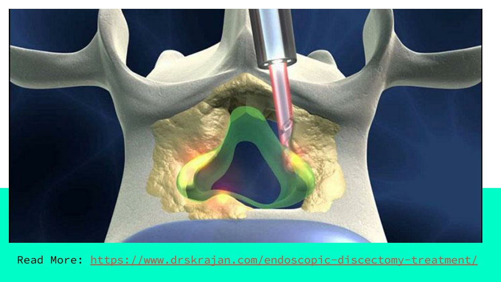 PPT - Endoscopic Discectomy Surgeon in Gurgaon PowerPoint Presentation ...