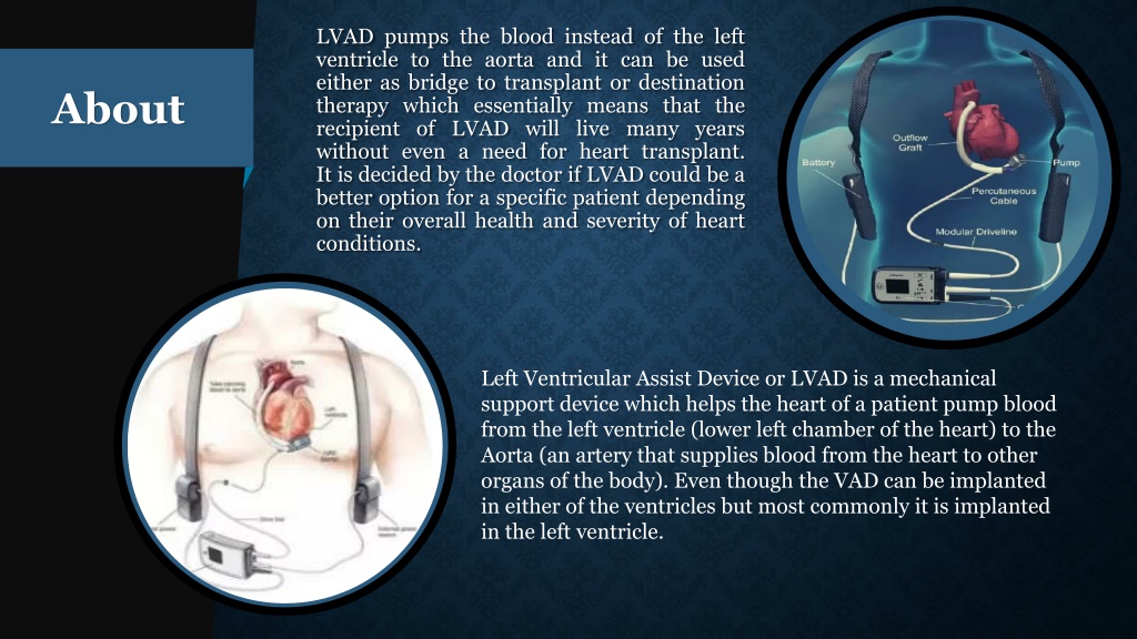 PPT - lvad heart pump life expectancy PowerPoint Presentation, free ...