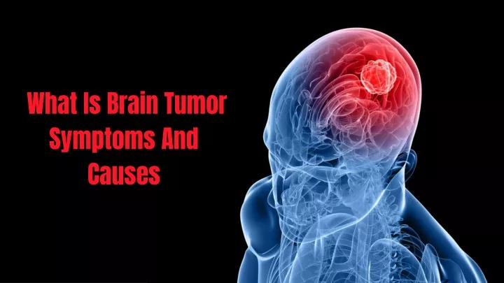 Ppt Dushyant Verma Southern Avenue What Is Brain Tumor Symptoms And