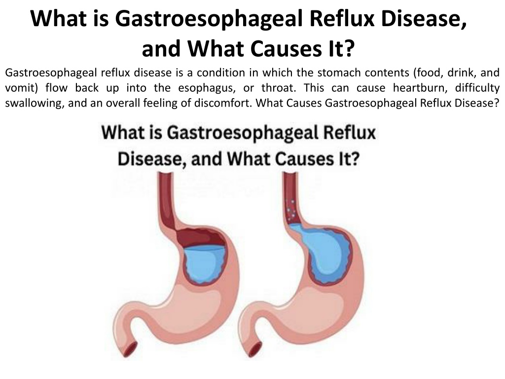 PPT - What Exactly Causes Gastroesophageal Reflux Disease PowerPoint ...