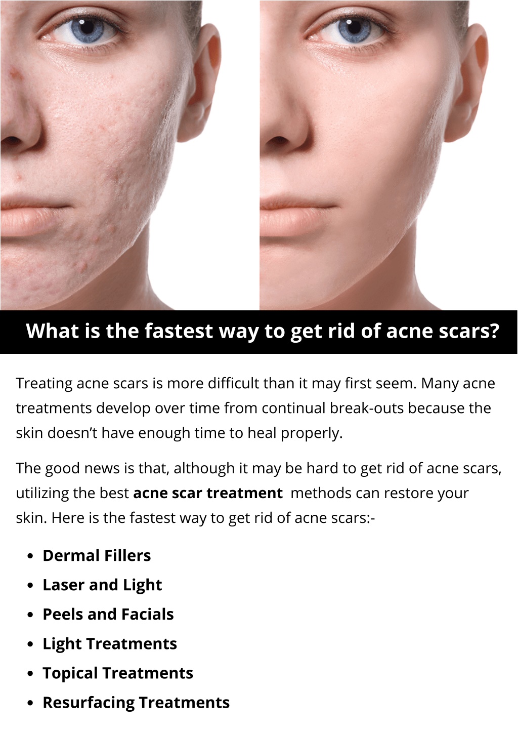 fastest way to get rid of acne scars naturally