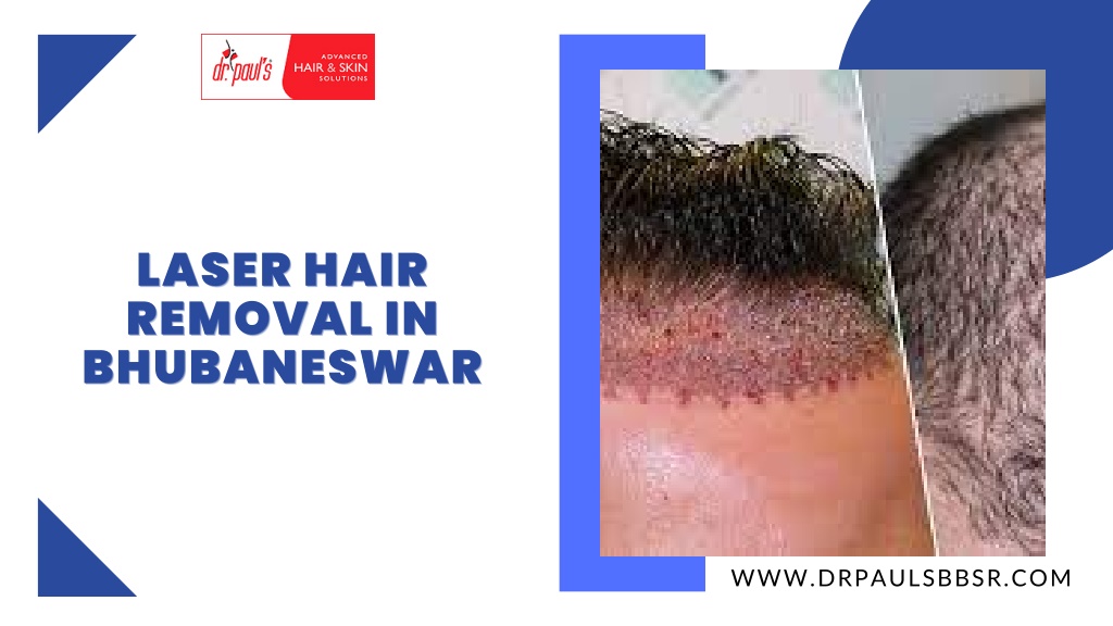 Ppt Laser Hair Removal In Bhubaneswar Powerpoint Presentation Free Download Id11957988 8275