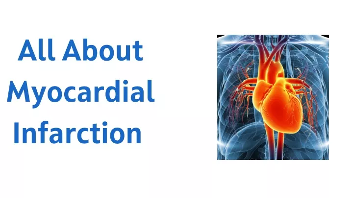 PPT - All About Myocardial Infarction PowerPoint Presentation, Free ...