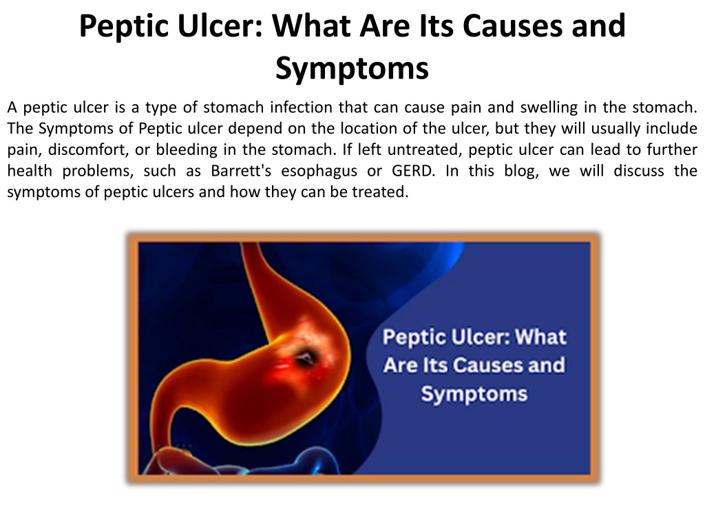 PPT - What Signs And Symptoms Indicate A Peptic Ulcer? PowerPoint ...