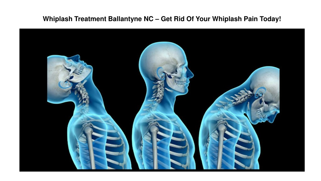 PPT - Whiplash Treatment Ballantyne NC – Get Rid Of Your Whiplash Pain ...