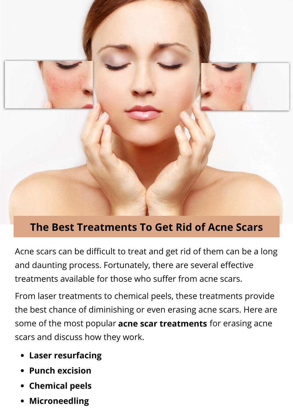 PPT - The Best Treatments To Get Rid Of Acne Scars PowerPoint ...