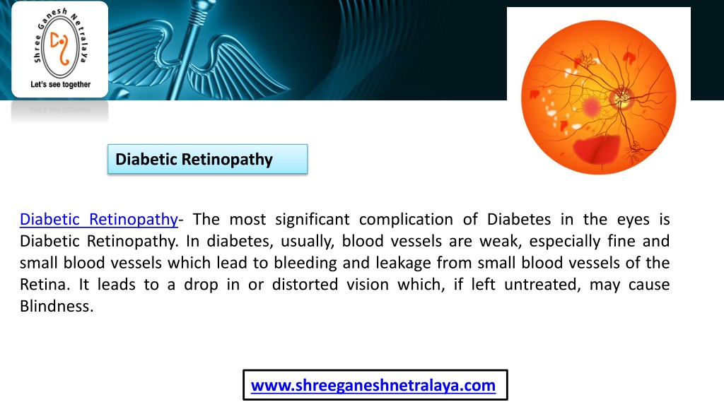 PPT Best Diabetic Retinopathy Treatment Specialist in Indore