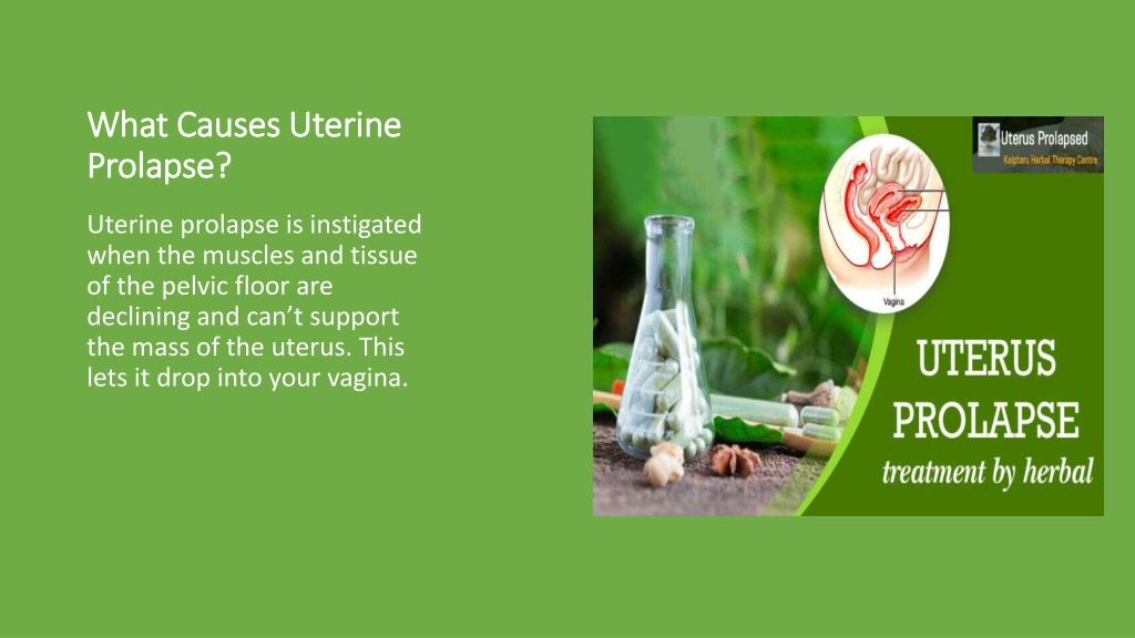 Ppt Uterine Prolapse Whats Everything You Need To Know Powerpoint Presentation Id12039671 