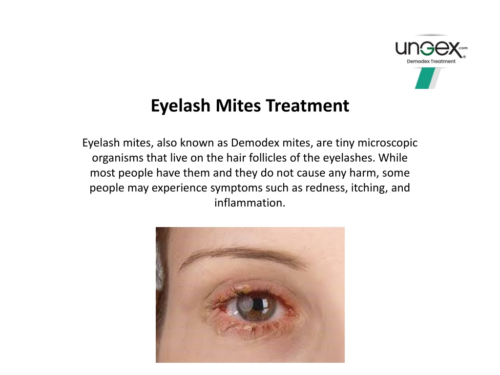 Ppt Eyelash Mites Treatment Powerpoint Presentation Free Download Id12057934 