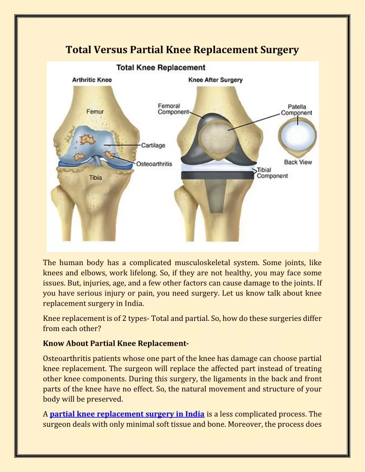 PPT Total Versus Partial Knee Replacement Surgery PowerPoint