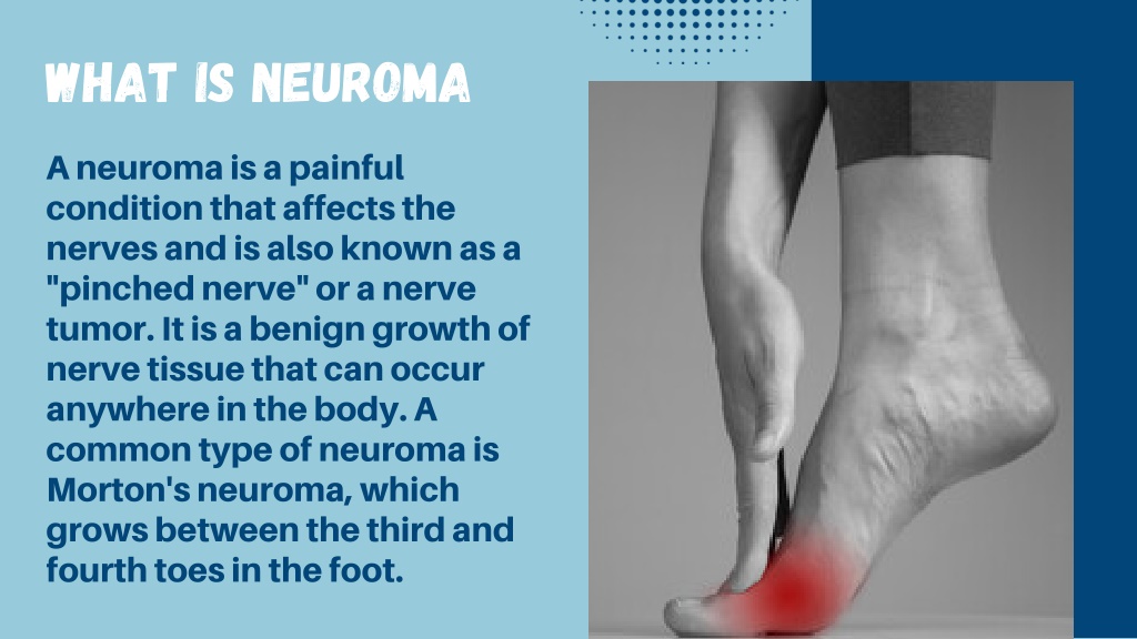 PPT - Neuroma Symptoms, Causes & Treatments PowerPoint Presentation ...