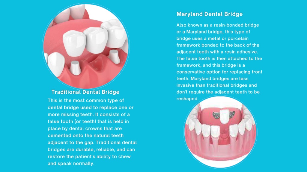 PPT - What are the Four Types of Dental Bridges PowerPoint Presentation ...