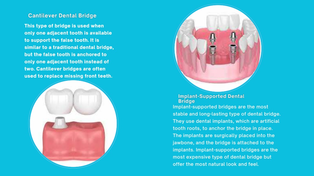 PPT - What are the Four Types of Dental Bridges PowerPoint Presentation ...